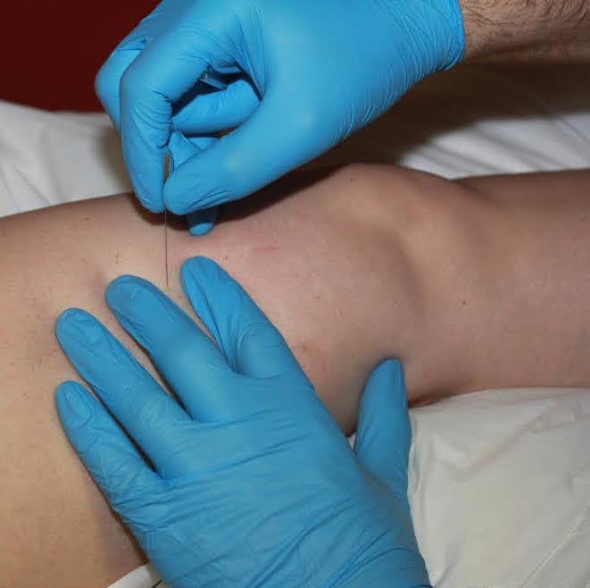 Dry Needling course for Pelvic Pain & Dysfunction by Dr Jan Dommerholt (Physiotherapist) USA
